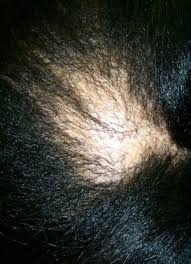alopecia picture