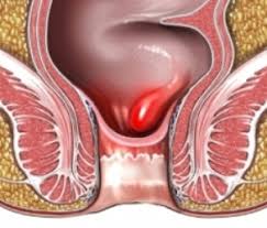 anorectal bleeding
