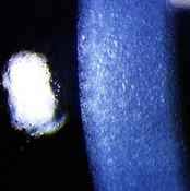 fuchs dystrophy
