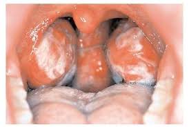 viral infections