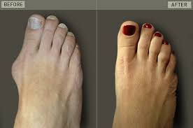 bunion operation