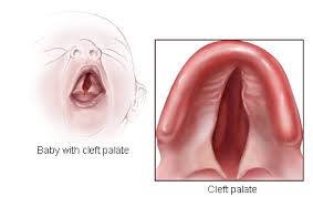 cleft lip palate