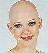 alopecia universalis