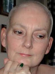 alopecia chemotherapy