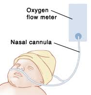 transient tachypnea of the newborn