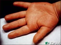 Kawasakis disease - edema of