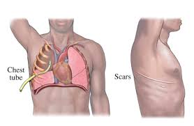 chest drain