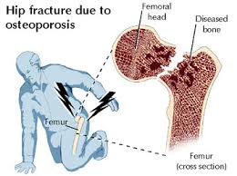 osteoporosis