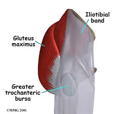 bursitis hip