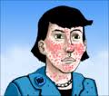 dietary rosacea