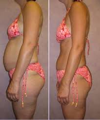 Of HCG Diet Patients