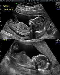 ultrasound at 16 weeks