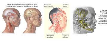 migraine symptoms