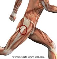 bursitis hip