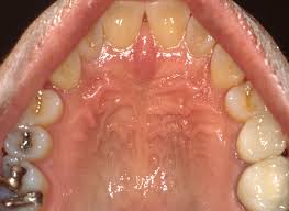 hard palate