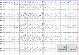 eeg patterns