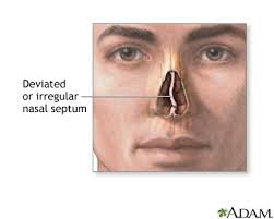 nose bone