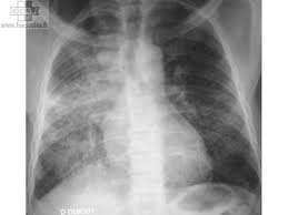 tuberculose miliaire