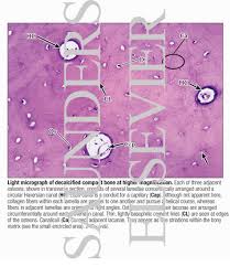 decalcification of bones