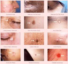 hemorroid treatment