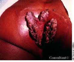 anorectal bleeding