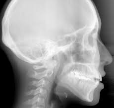 cephalometric radiograph