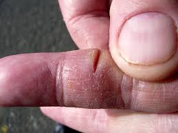 finger cut