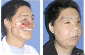 face transplants can