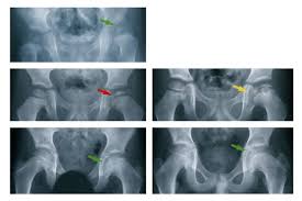 perthes disease
