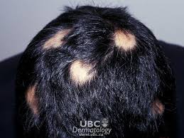 alopecia hair