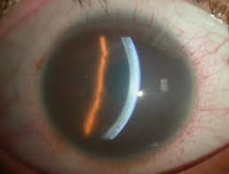 fuchs dystrophy