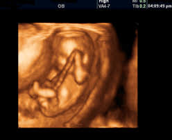 3d ultrasound pictures