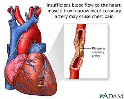 cardiac pump