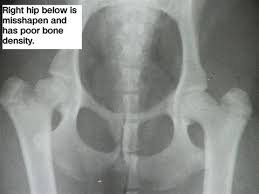 perthes disease