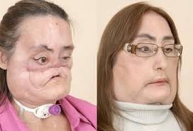 Face Transplant Patient,