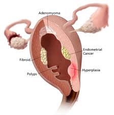 uterus cancer