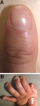 spatulate fingertips
