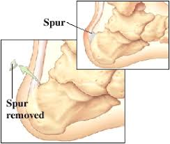 bone spurs in feet