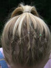 alopecia women