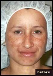 cosmelan peeling