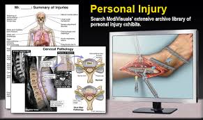 personal injury