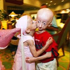 progeria patients