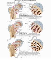 perthes disease