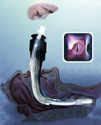 airtrac laryngoscope