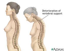 osteoporosis