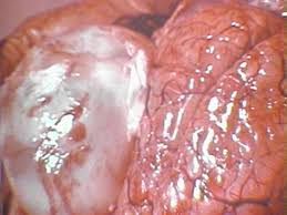 brain cyst