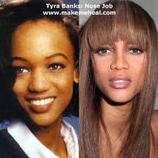 nose reconstruction