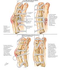 bunion operation