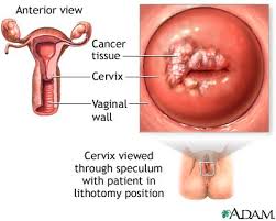 Cervical cancer