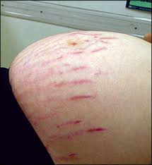 stretchmarks